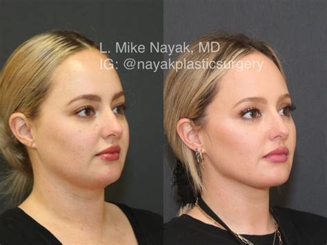 stl cosmetic surgery|Nayak Plastic Surgery St. Louis Cosmetic Surgery.